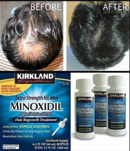Comprar minoxidil 5% 60ml original - kirkland preço no brasil minoxidil suplemento importado loja 11 online promoção - 26 de julho de 2022